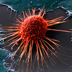 Удаление миомы: есть опасность распространения рака? 